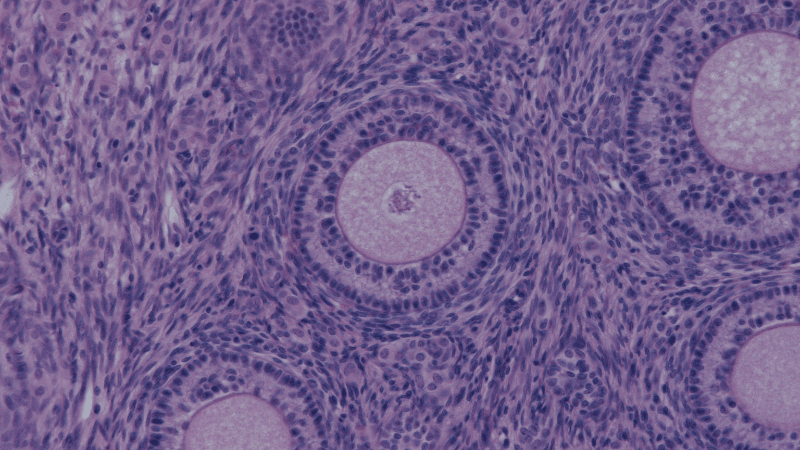 How We Do It: What Do Current Data for ADCs Tell Us About Real World Care for Platinum-Resistant Ovarian Cancer?